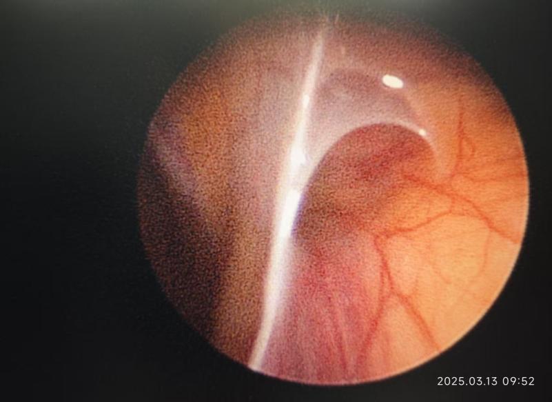 2mm腹腔镜下单孔手术切口