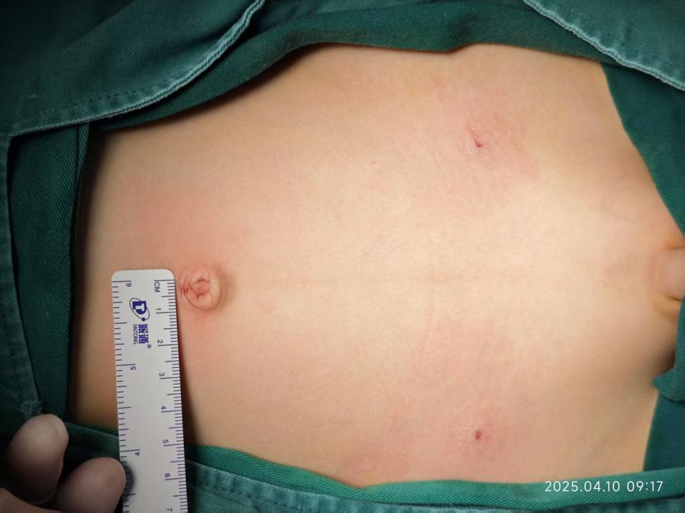 2mm腹腔镜下双侧内环口未闭的情况