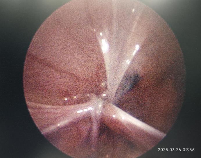 2mm腹腔镜下单孔结扎内环口完毕 2mm腹腔镜术后切口情况