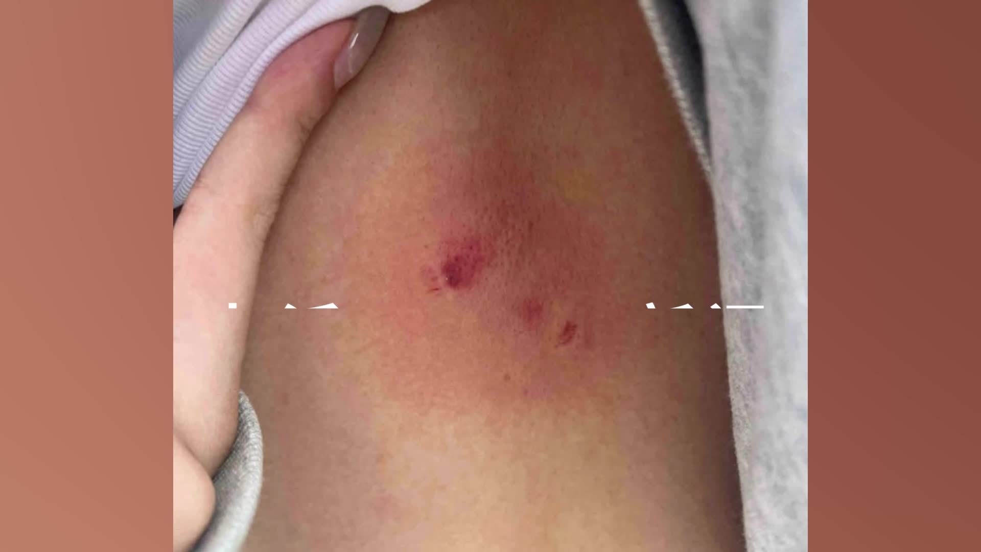 黔灵山公园猕猴咬伤游客背部，公园：已消毒处理，狂犬疫苗费用可报销