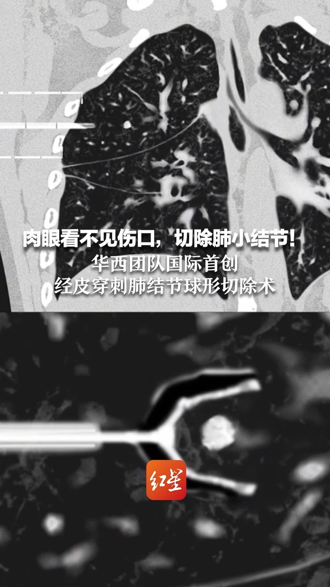 肉眼看不见伤口，切除肺小结节！华西团队国际首创经皮穿刺肺结节球形切除术