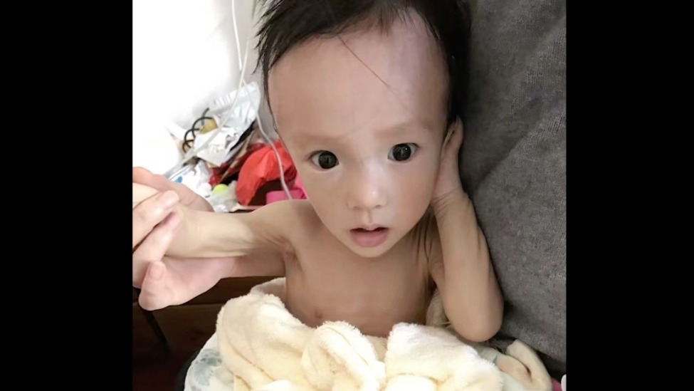 不到半岁的男孩瘦到屁股只剩一张皮，检查完后被医生说吸收不良，姥姥一跪查出鸡蛋大的脑瘤