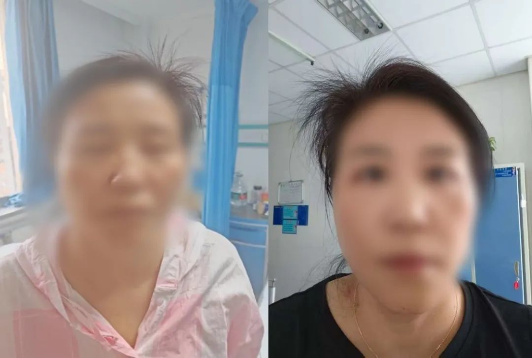 入院时双侧面瘫 用药5天后，双侧面瘫明显改善