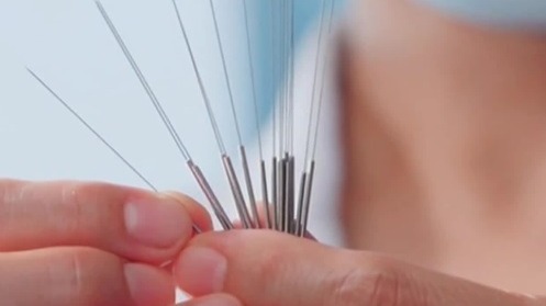 针灸不仅能治病，还能减肥？英国王室都要求助中医