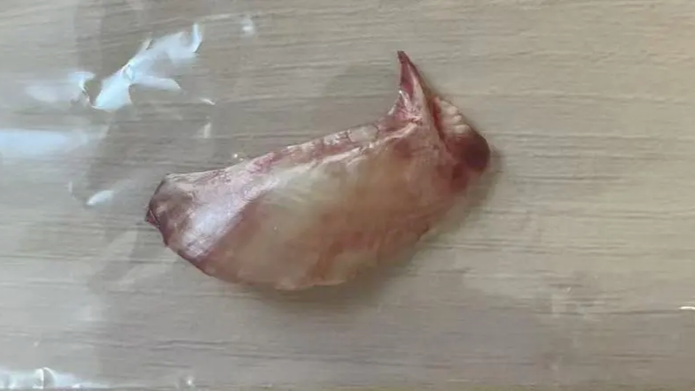 拔鱼刺花了85元，患者转头把医生投诉了