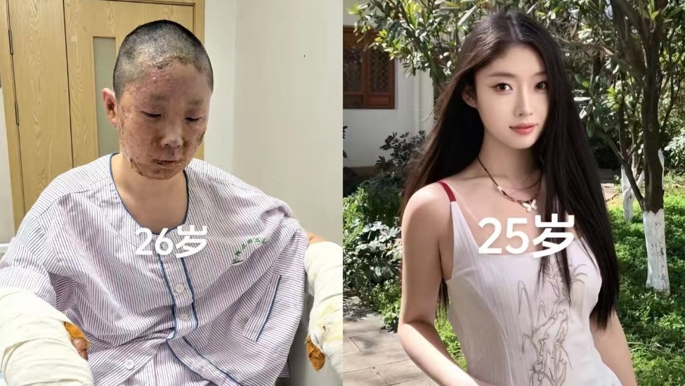 27岁美妆博主烧伤毁容：与自己和解，打算重新做美妆账号