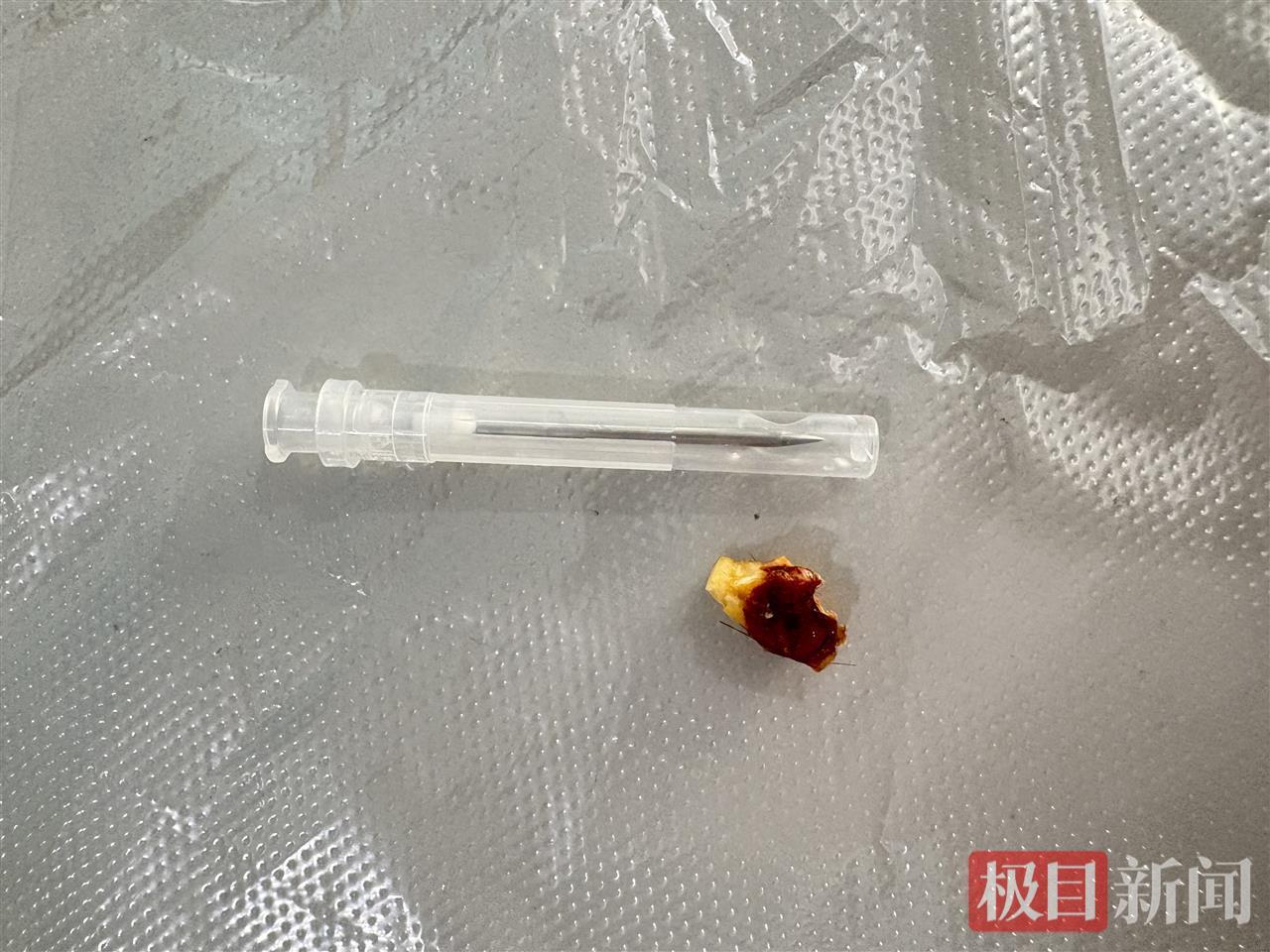 橡皮擦碎潜伏男童耳内2年引发剧痛 医生1分钟掏出异物