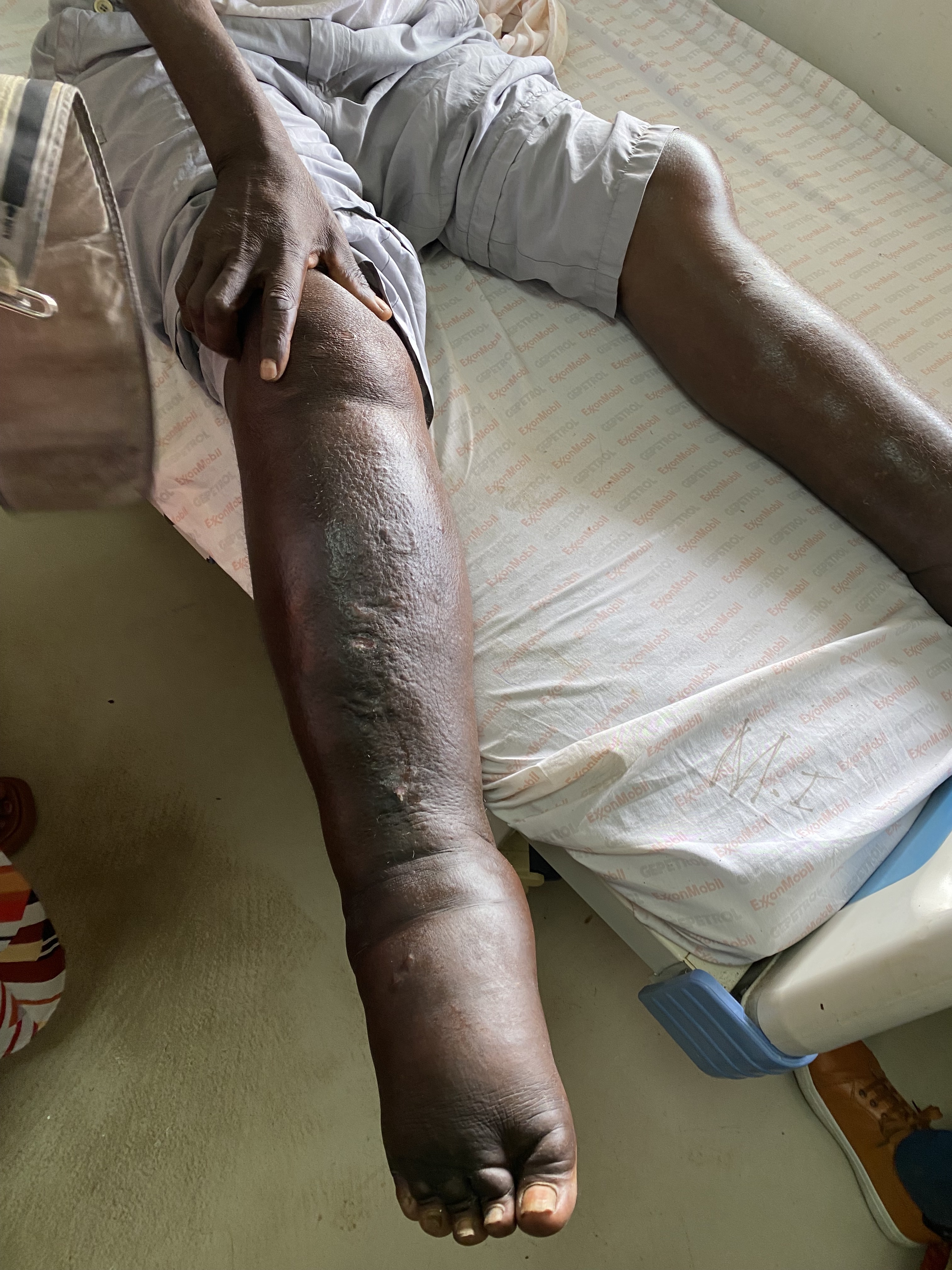 慢性淋巴丝虫病患者患肢“象皮肿”