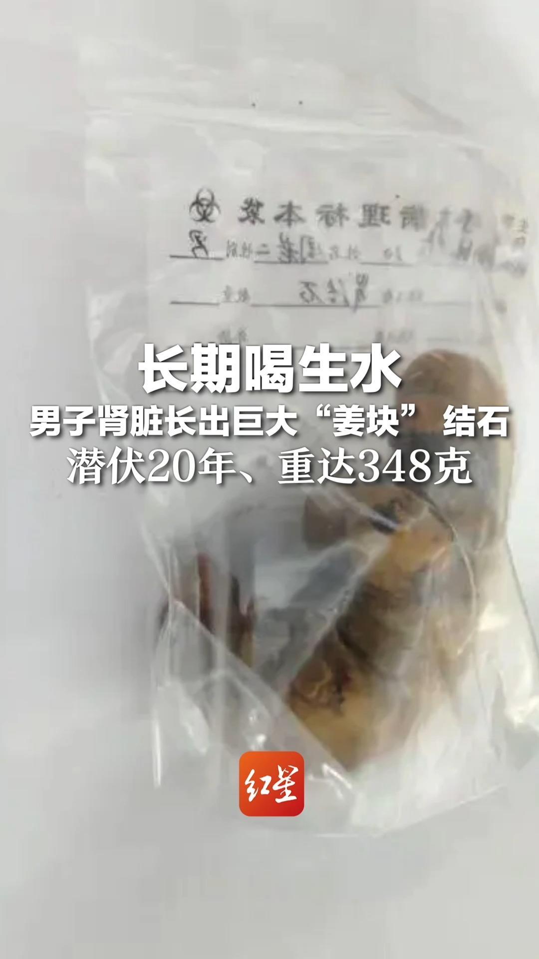 长期喝生水 男子肾脏长出巨大“姜块” 结石 潜伏20年、重达348克