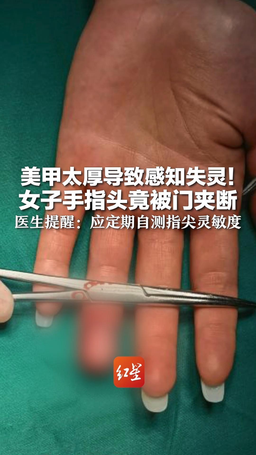 美甲太厚导致感知失灵！女子手指头竟被门夹断  医生提醒：应定期自测指尖灵敏度