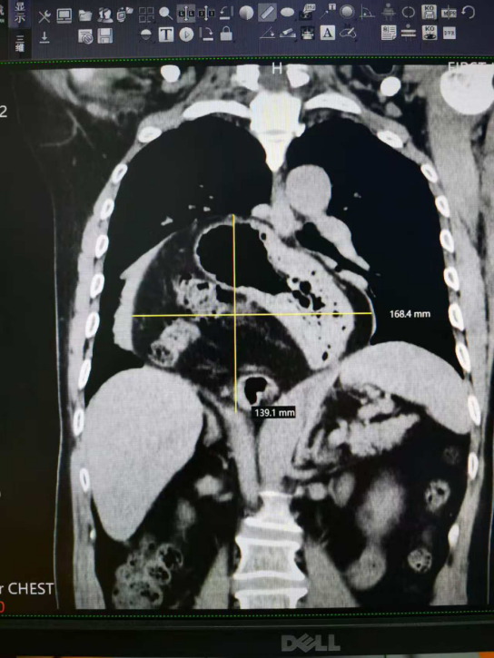 CT提示胃及部分肠管疝入胸腔,大小约16.8cmx13.9cm
