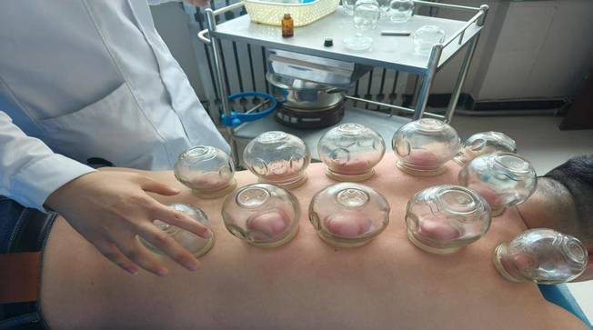 艾灸拔罐齐上阵　华亭中医理疗收获一波好评