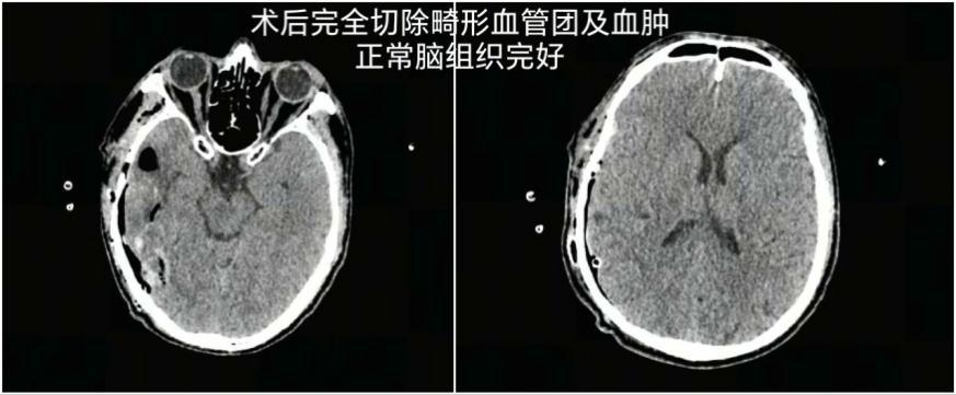 57岁大叔脑动静脉破裂出血！深圳医生极速“拆弹”