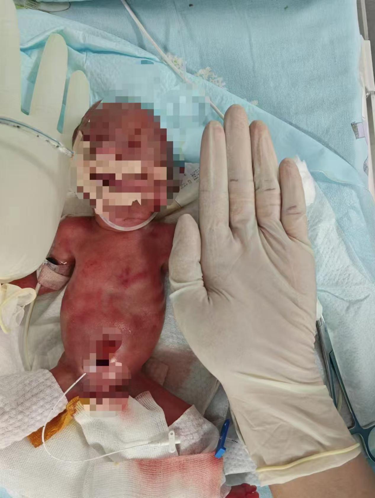 图为:超早产儿“巴掌宝贝”。