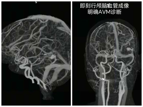 57岁大叔脑动静脉破裂出血！深圳医生极速“拆弹”