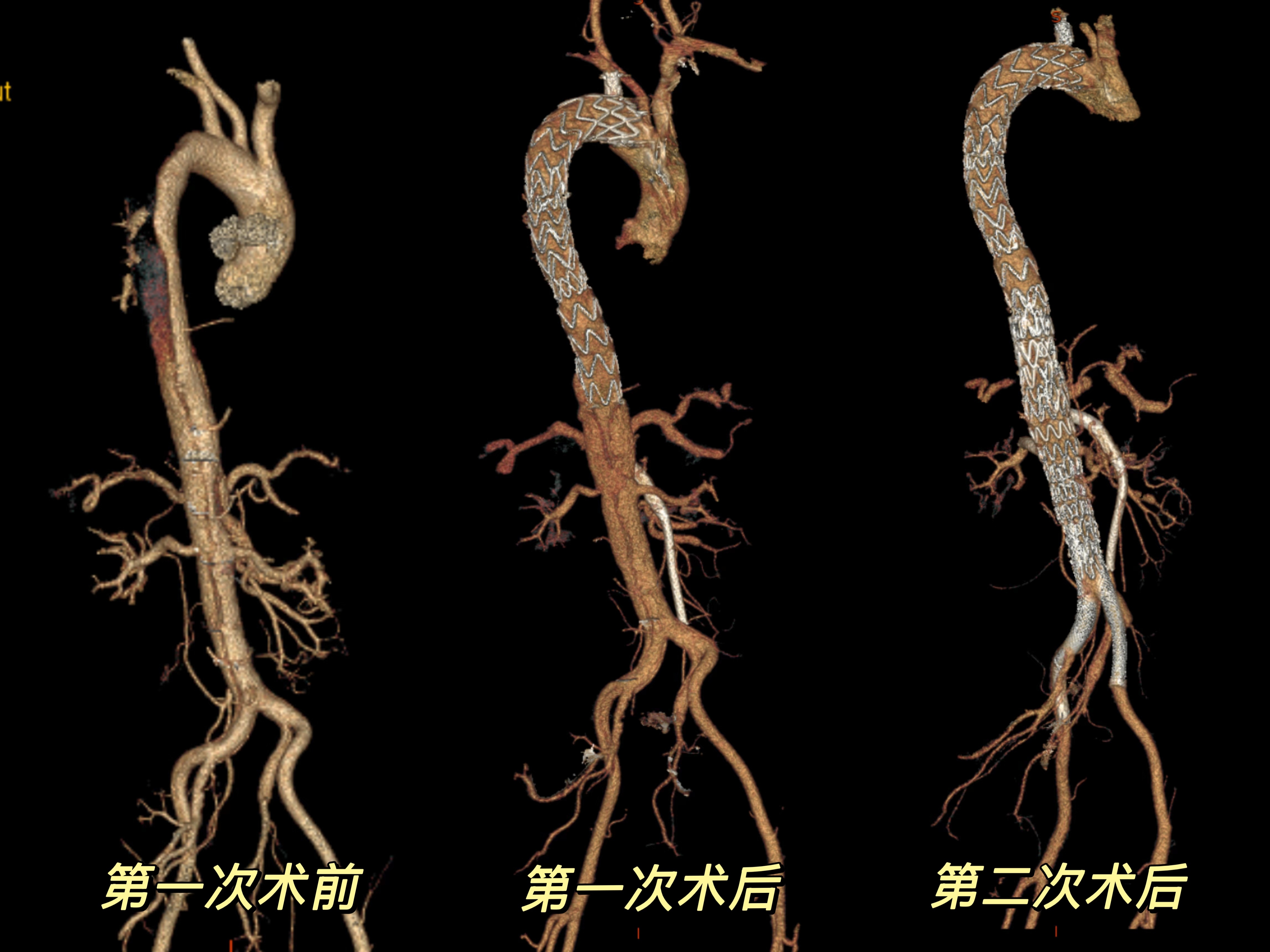 新技术“合璧”血管，中大医院专家攻克复杂主动脉夹层后顾之忧