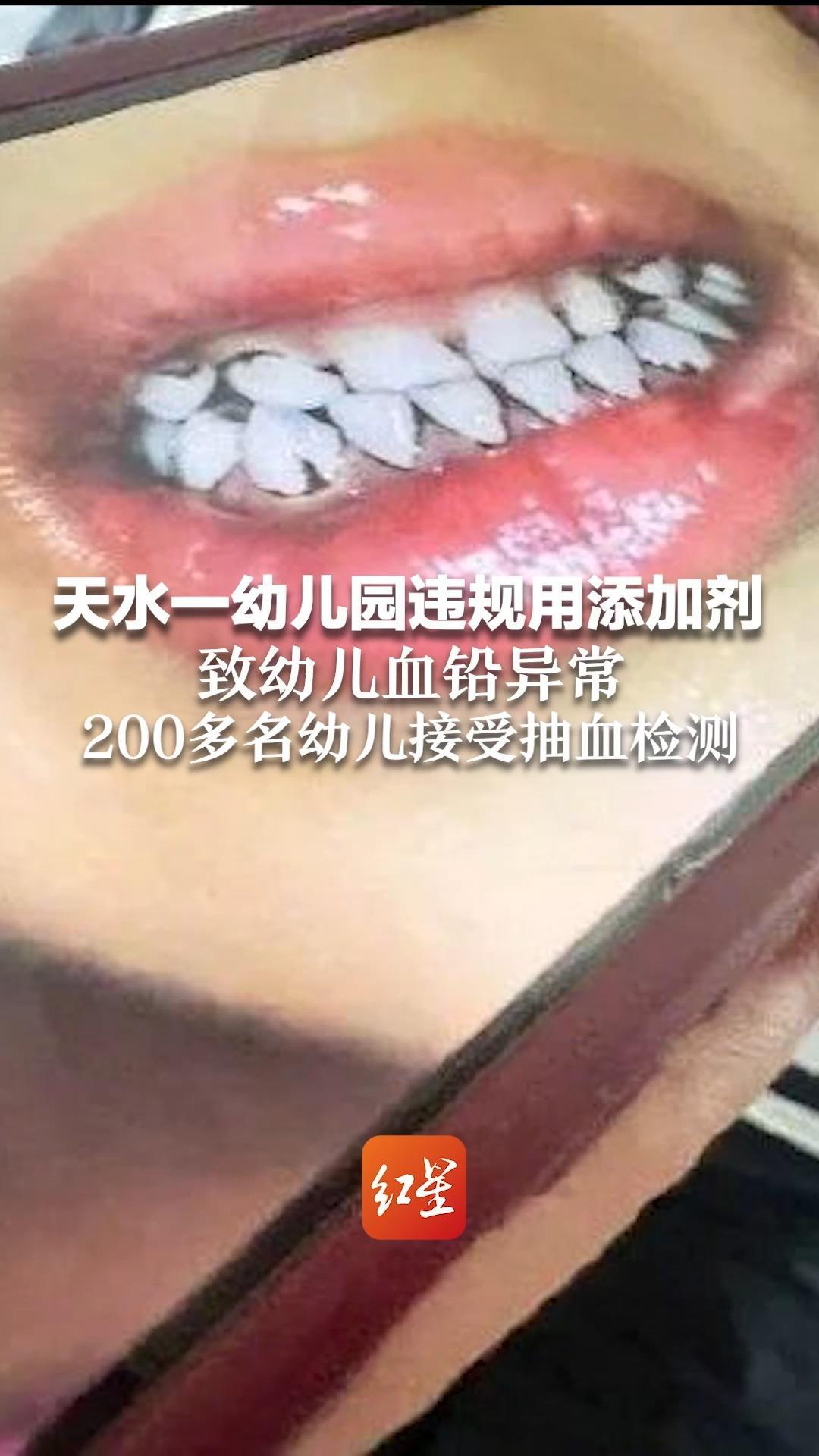 幼儿园违规用添加剂致幼儿血铅异常 200多名幼儿接受抽血检测 铅中毒源头尚未查明，案件仍在调查