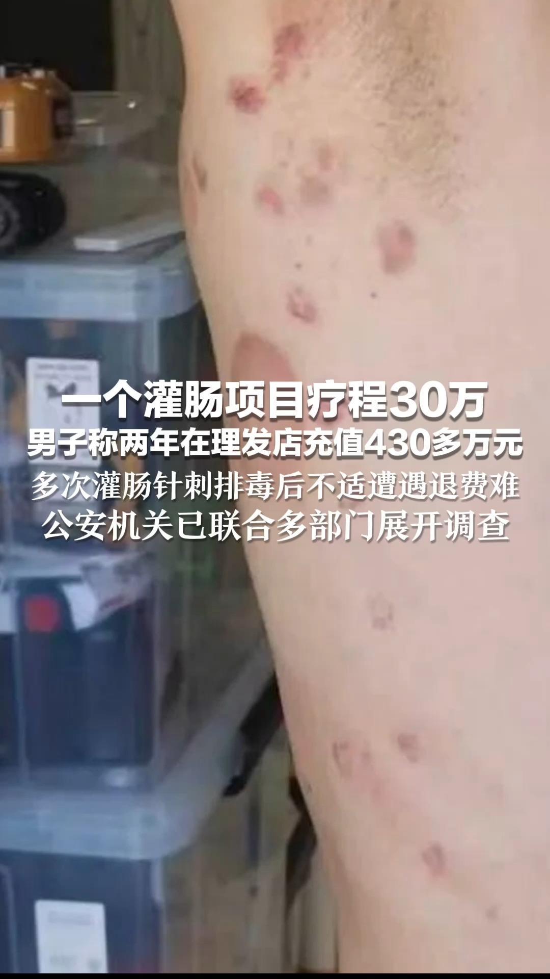 一个灌肠项目疗程30万 男子称两年在理发店充值430多万元 多次灌肠针刺排毒后不适遭遇退费难 公安机关已联合多部门展开调查