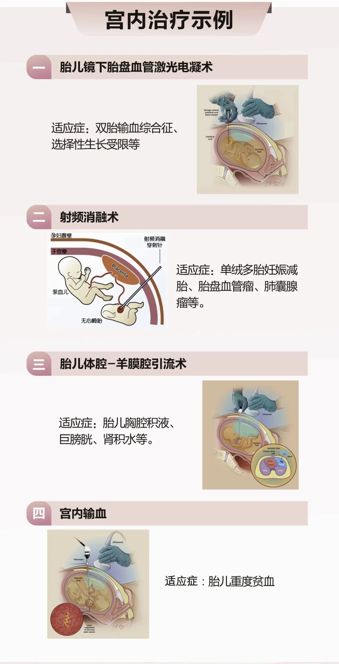 人人都羡慕她“四胞胎”,她却为“减胎”四处求医碰壁