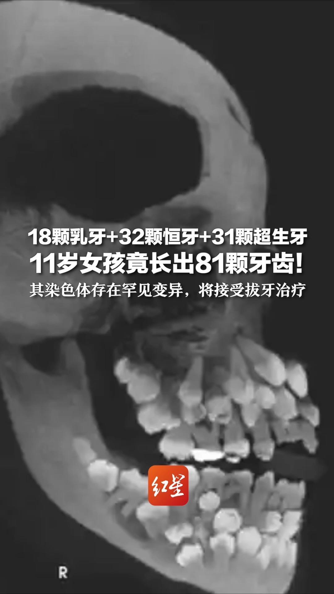 18颗乳牙+32颗恒牙+31颗超生牙 11岁女孩竟长出81颗牙齿！其染色体存在罕见变异，将接受拔牙治疗