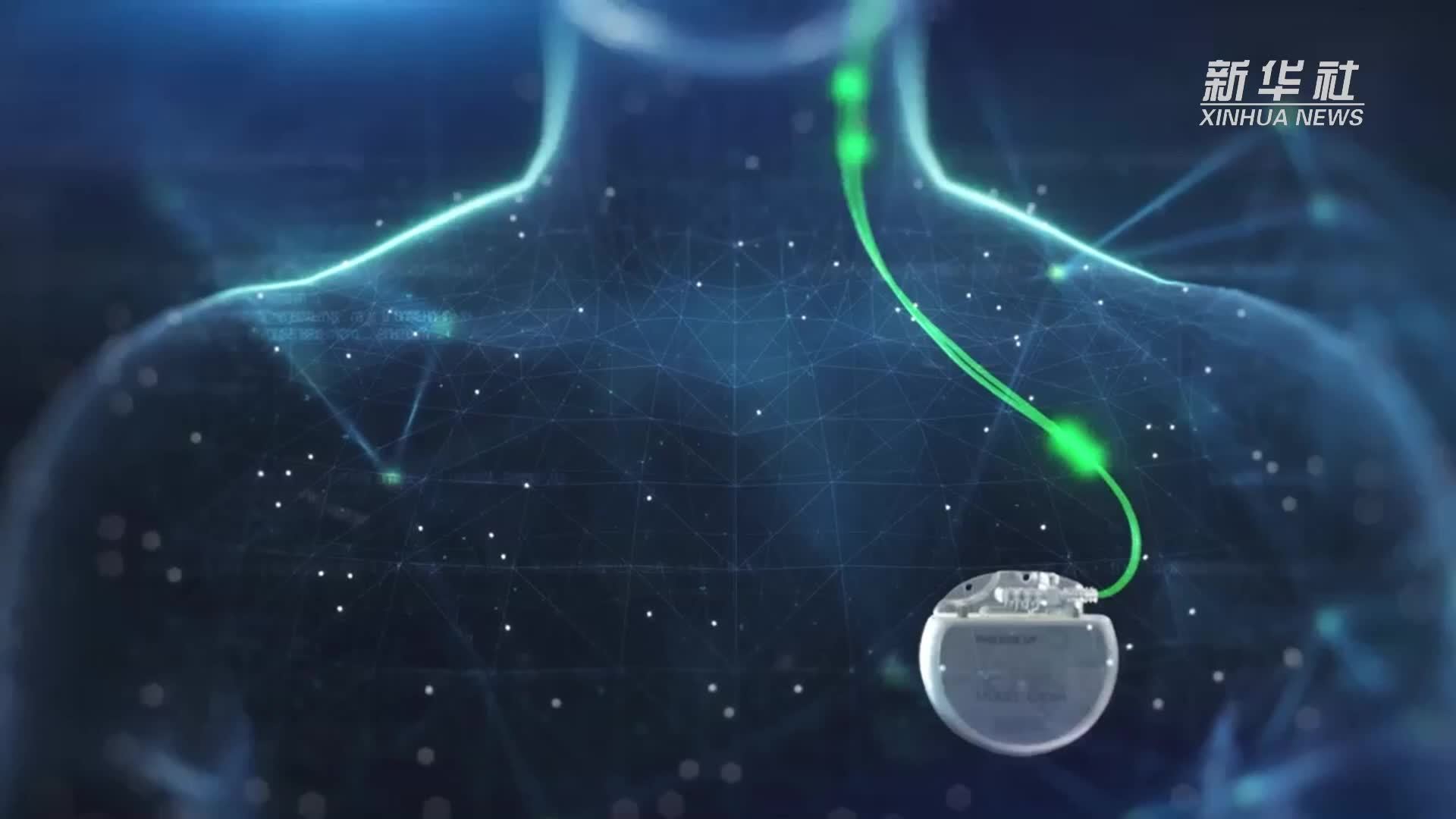 中国经济样本观察·企业样本篇｜让中国人用上自己的脑起搏器