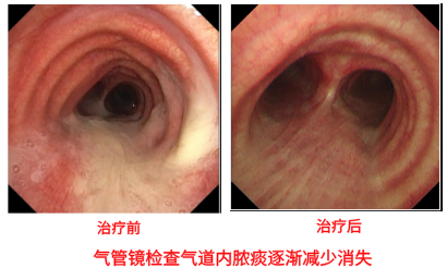 噬菌体显神通?支气管扩张合并耐药铜绿假单胞菌感染的“破局”治疗