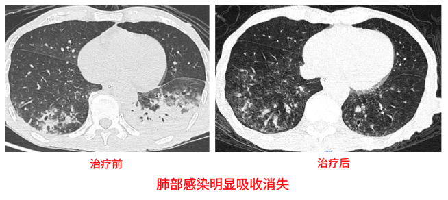 噬菌体显神通?支气管扩张合并耐药铜绿假单胞菌感染的“破局”治疗