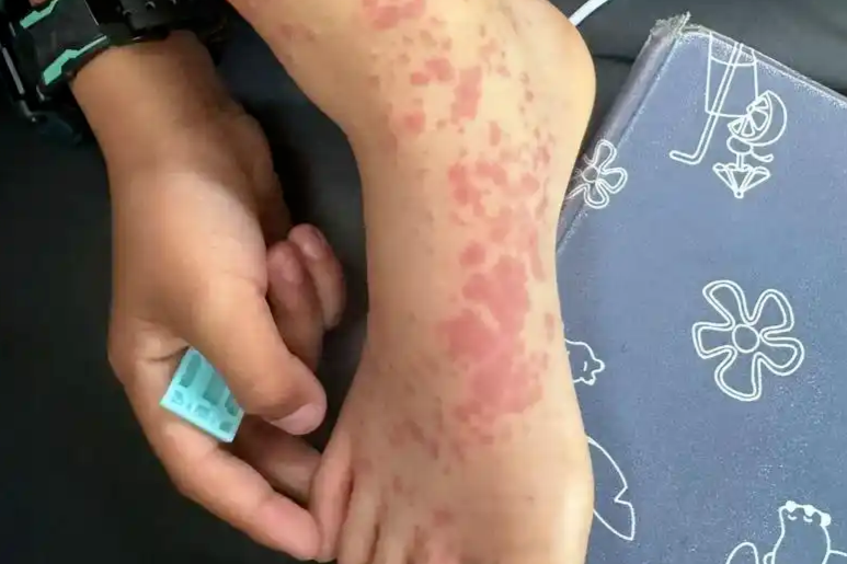 这个用错100多年的病名，早该改了！多名专家呼吁_凤凰网健康_凤凰网