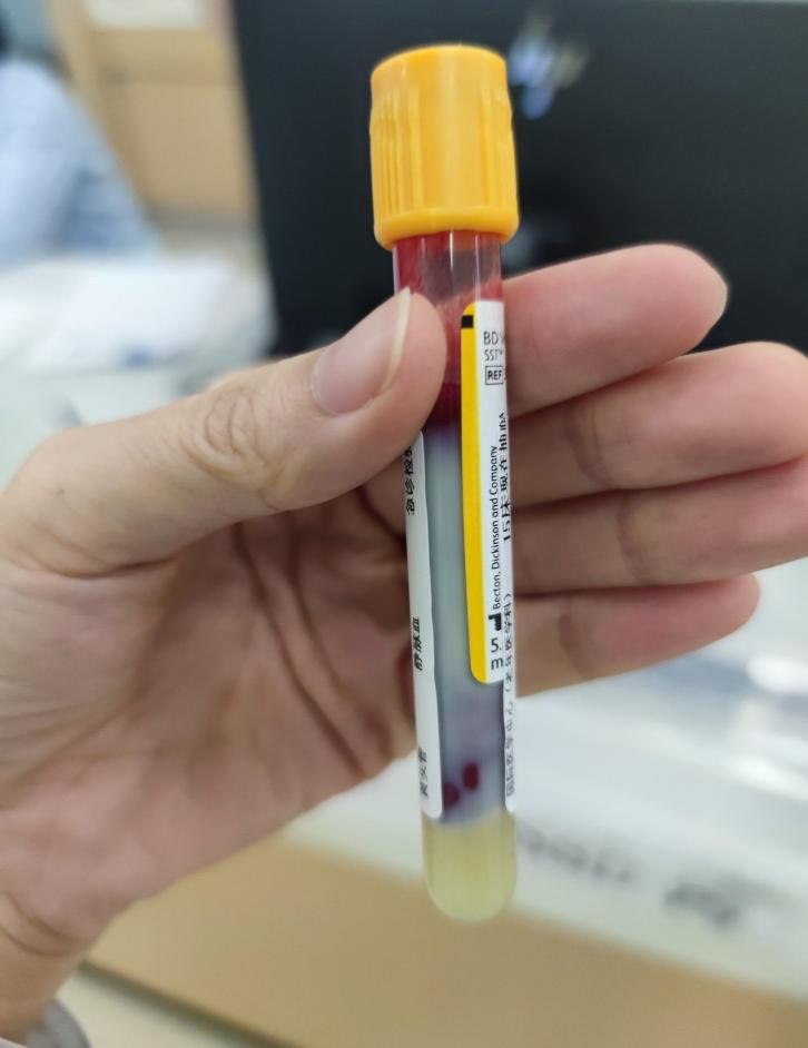 静置后的血液标本,肉眼可见厚厚乳白色油脂