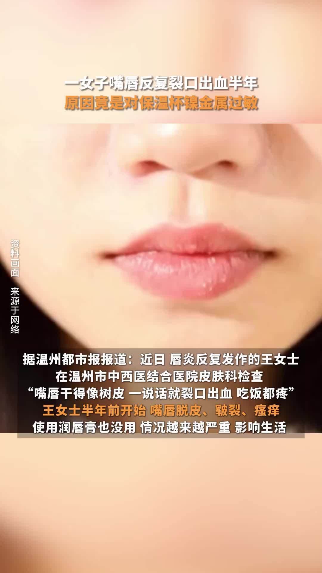 一女子嘴唇反复裂口出血半年，原因竟是对保温杯镍金属过敏
