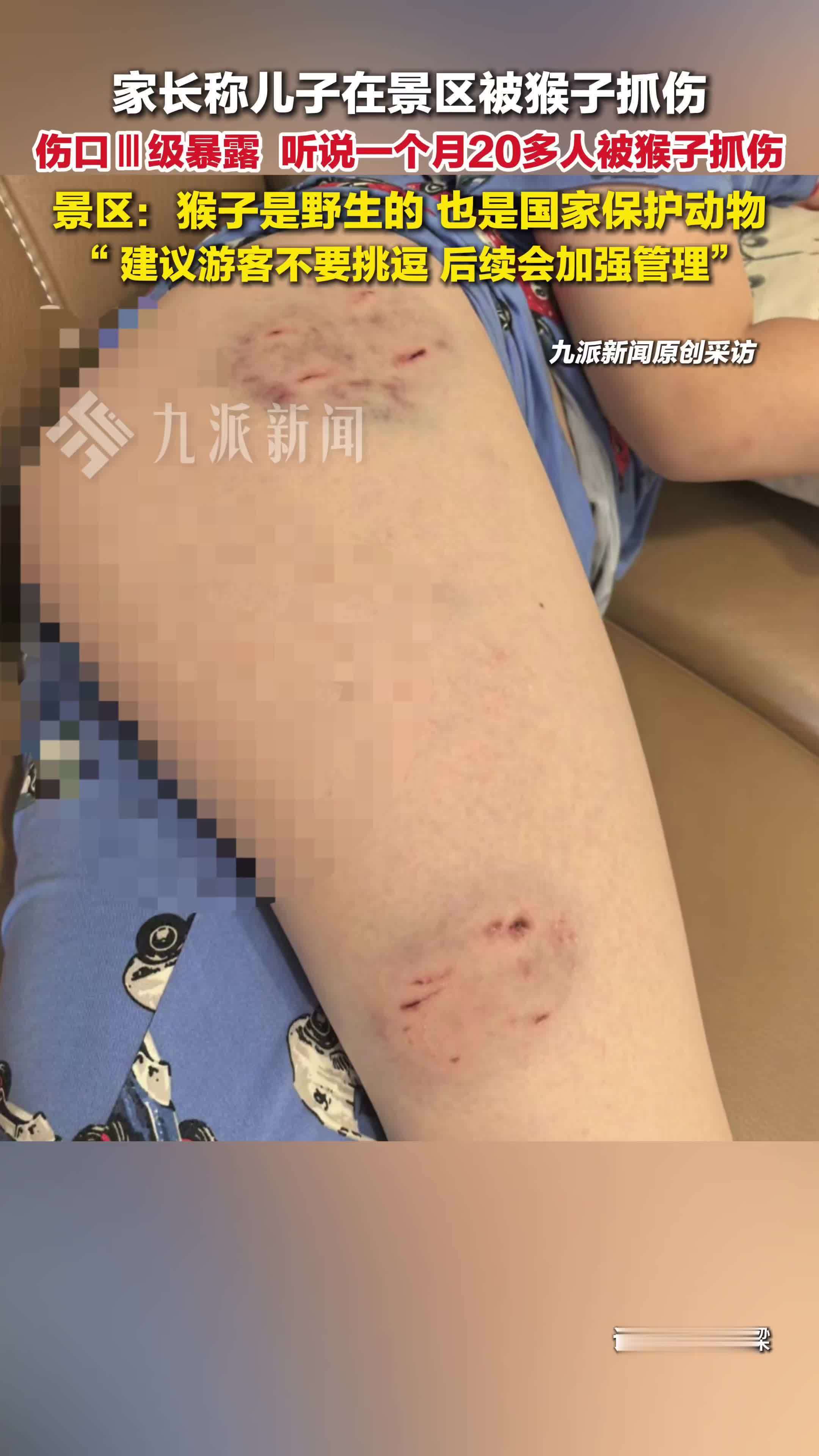 景区回应男孩被猴子抓伤
