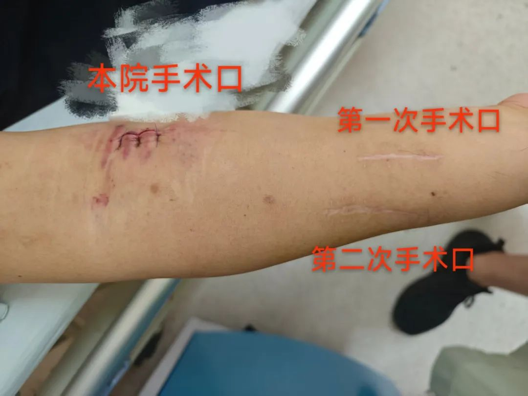 韩国患者血管通路遇难题，深圳专家紧急手术解危机