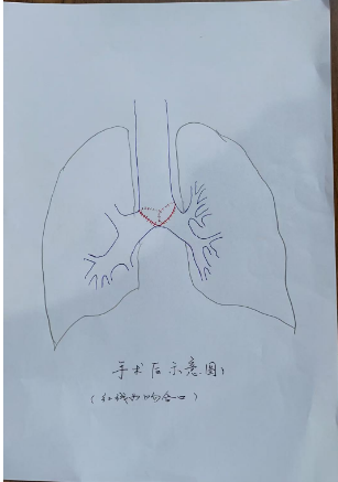 胡江文主任医师手绘：气管隆突肿瘤手术前后示意图
