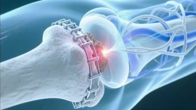 3D打印技术，让重塑肉身不再是梦？