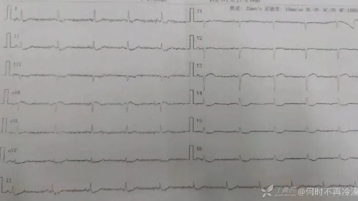 胸痛仅 1 天,心肌酶、肌钙蛋白均正常,却抢救无效死亡