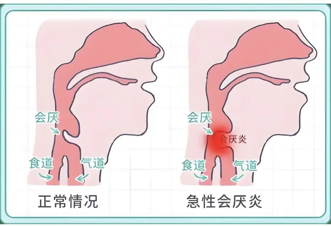 吞咽不适、异物感持续加重?警惕会厌囊肿找上门凤凰网陕西_凤凰网
