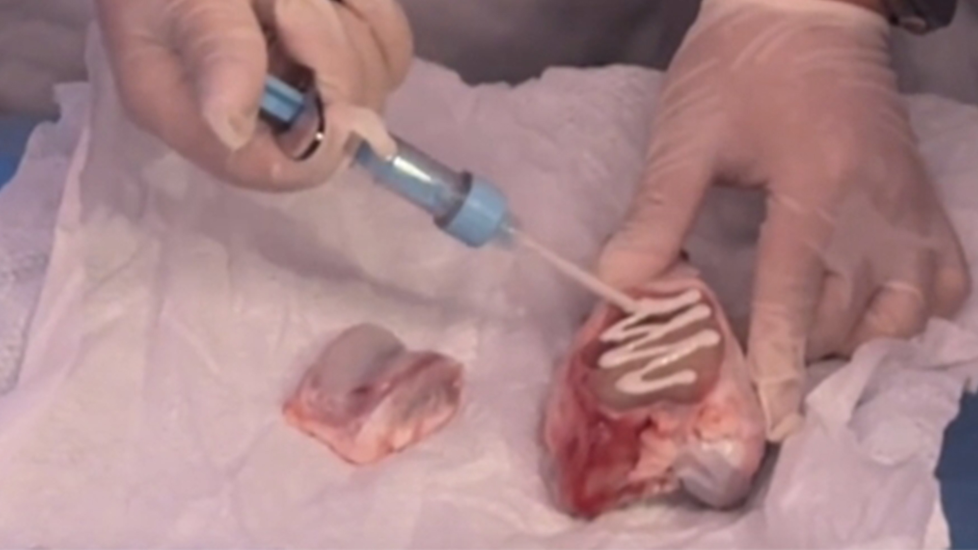 骨折不用二次开刀，打一针胶水就行了！全球首款“骨胶水”来了，2-3分钟即时粘合，随骨愈合自然吸收