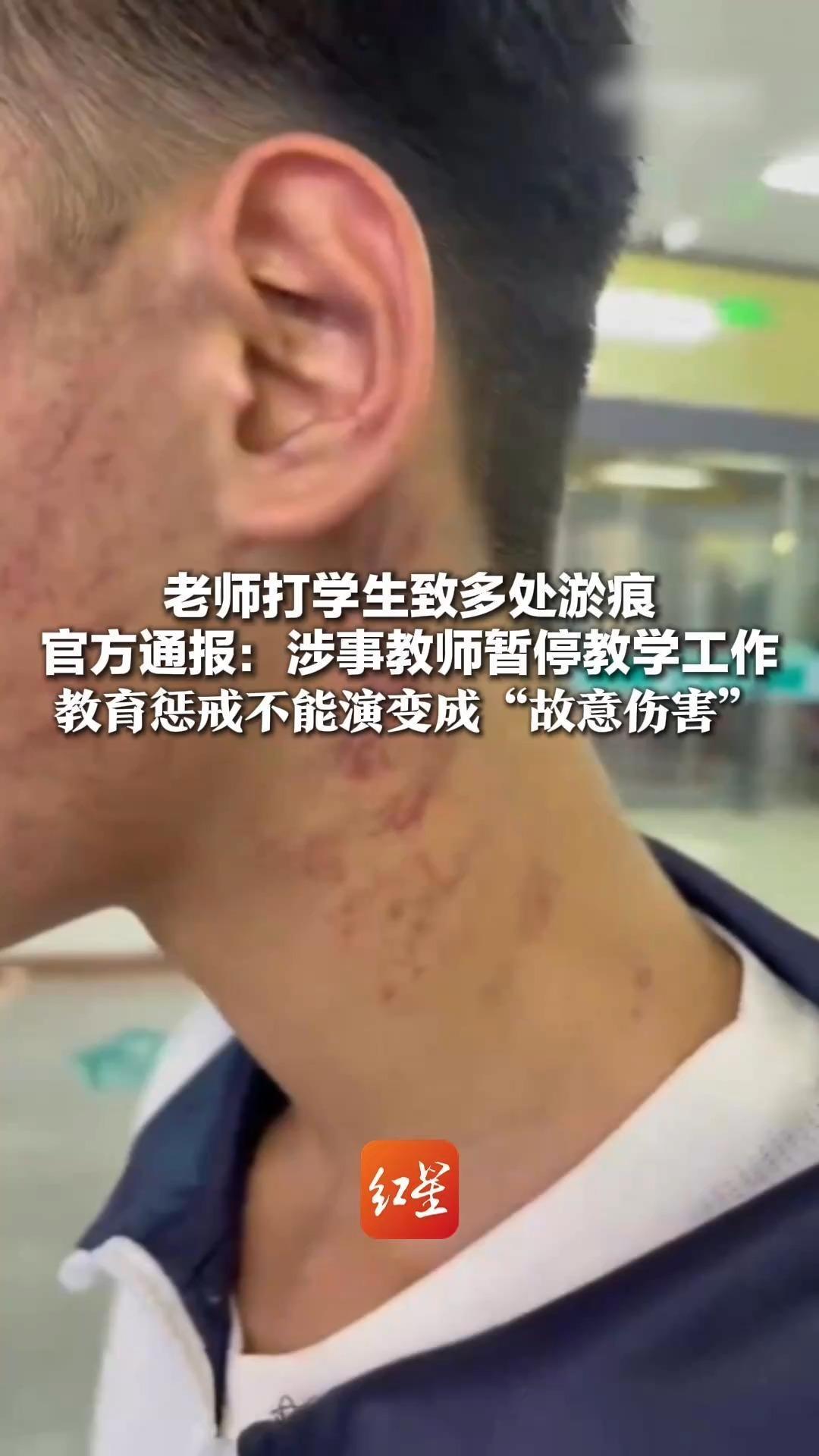 老师打学生致多处淤痕 官方通报：涉事教师暂停教学工作 教育惩戒不是体罚 更不能演变成故意伤害
