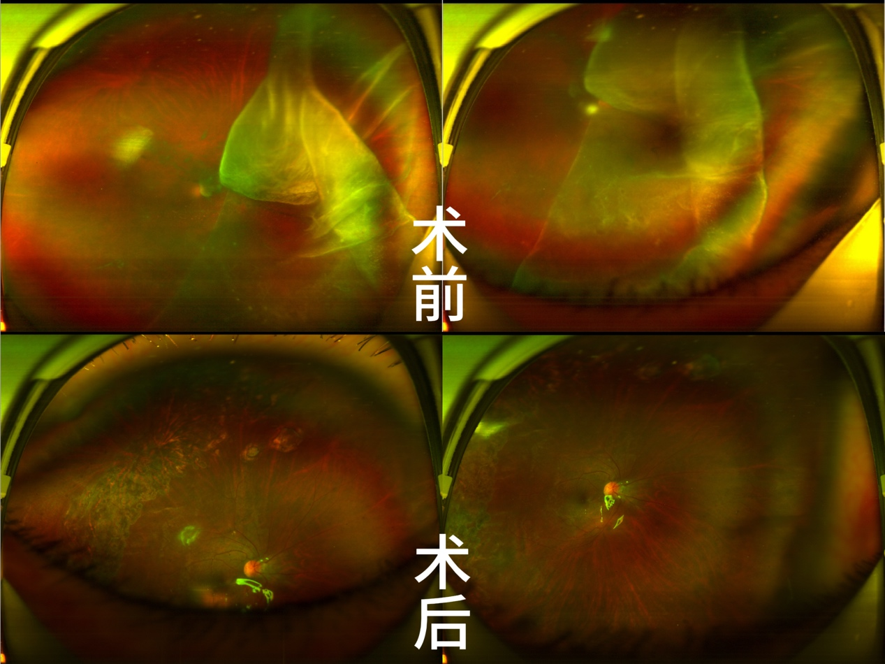 一面锦旗，万分感激：27岁青年突发视网膜脱离，博士团队争分夺秒抢救光明