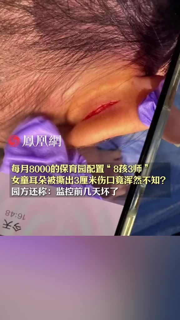 一个月8000余元的“高端”保育园配置“8孩3师”，女童耳朵被撕出3厘米伤口竟浑然不知？园方还称：监控前几天坏了，家长：血都流到短袖上了，3个老师都说不知道 #教育  #幼儿园  #孩子  #学校