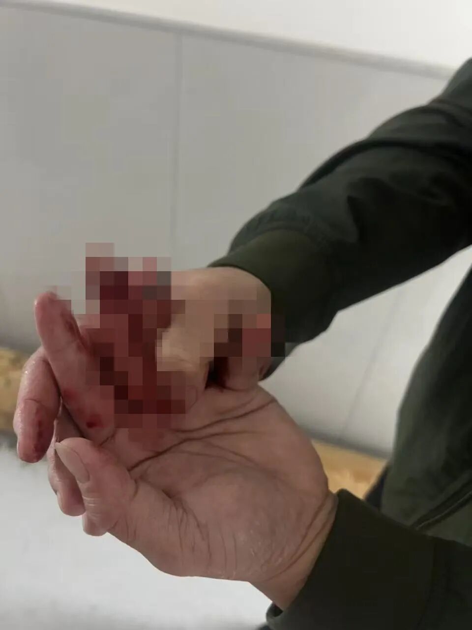 民警出差途中偶遇交通事故为救群众手部重伤(图2)