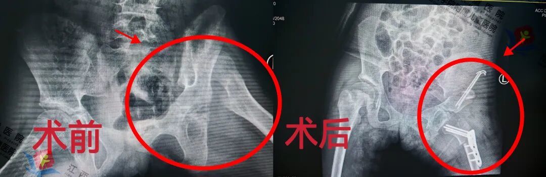 告别10余年跛行！江西省儿童医院骨科助12岁女童“髋”然一新