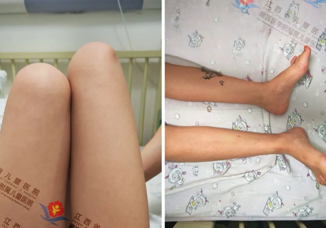 告别10余年跛行！江西省儿童医院骨科助12岁女童“髋”然一新