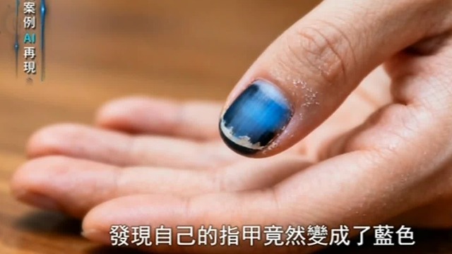 一觉醒来，指甲、皮肤和血液都变成蓝色？低氧血症在作怪