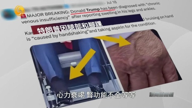 手背淤青、脚踝肿胀，特朗普健康问题遭质疑，白宫坐不住了