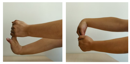 皮囊炎图片手臂 EAB1AFC4BA784F4E3C5C6326C766A40A27881086_size111_w525_h262.png