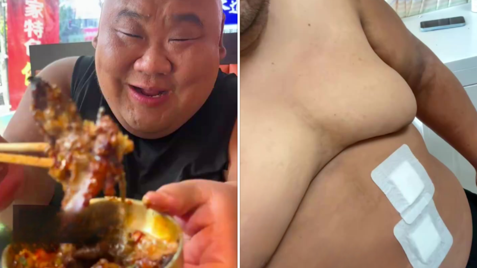 百万粉丝吃播网红切胃减肥，曾重达350斤，术后三天已瘦20多斤