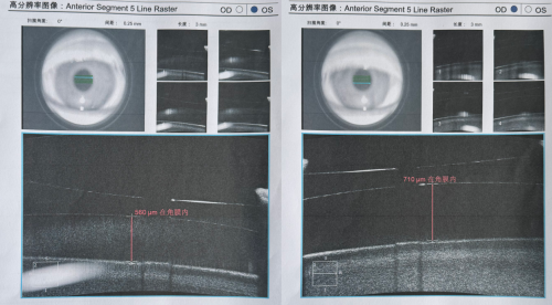 千里赴深!云南袁女士告别 1100 度近视,术后首日视力达 1.2