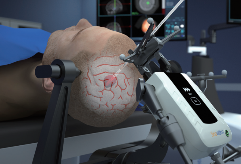 传统开颅 vs 机器人微创:脑出血治疗为何“越小越安全”?