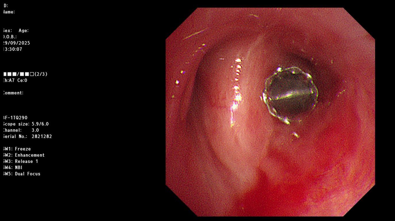 图为置入活瓣后